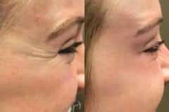 Botox before and after results — patient 1
