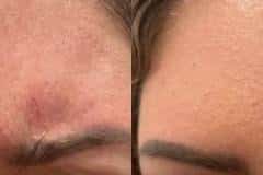 Botox before and after results — patient 2