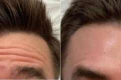 Botox before and after results — patient 3