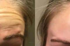 Botox before and after results — patient 4