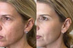 Chemical Peel before and after results — patient 1