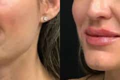 Fillers before and after results — patient 1
