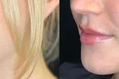Fillers before and after results — patient 2