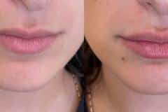 Fillers before and after results — patient 3