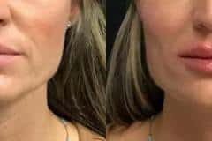 Fillers before and after results — patient 4