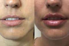 Fillers before and after results — patient 5