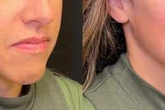 Fillers before and after results — patient 6
