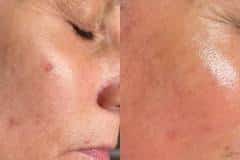 Microneedling before and after results — patient 1