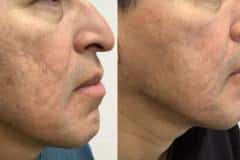 Microneedling before and after results — patient 2