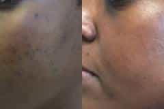Microneedling before and after results — patient 3