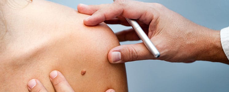 Mohs Surgery Dallas TX