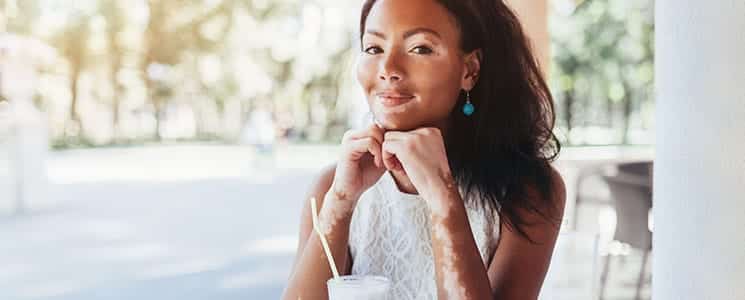 Vitiligo Treatment Dallas TX