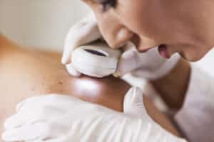 Mohs Surgery Texas