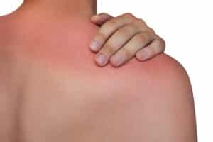 Sun Damage Treatment Dallas TX