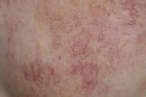 Closeup of skin with rosacea flare-up