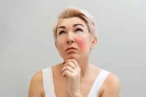 Woman with rosacea flare-up on cheek