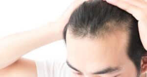 A man with hair disease pulling back his hair