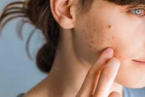A close-up shot of acne on a woman's cheek