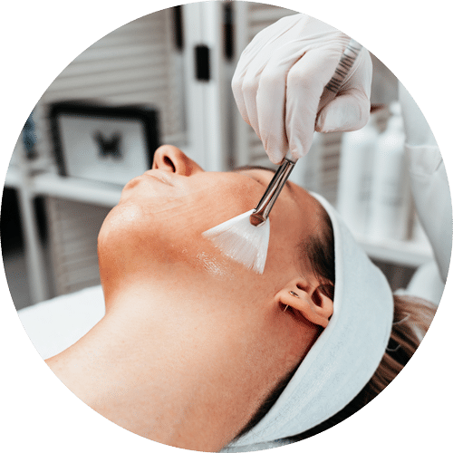 Chemical Peel