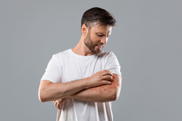 Man with a skin condition scratching his arm