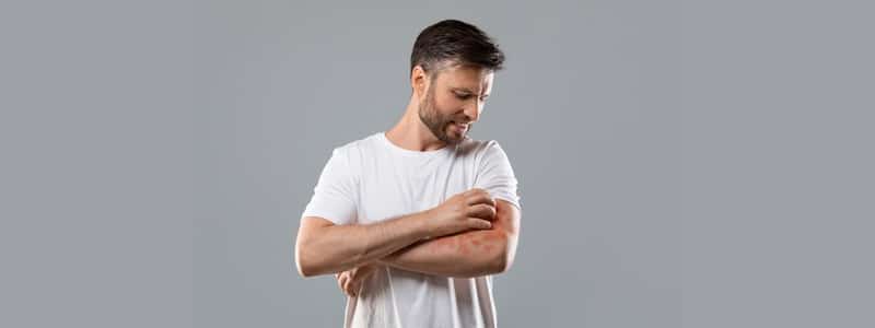 Man with a skin condition scratching his arm